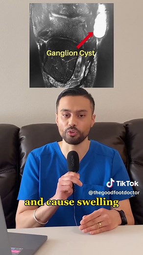 How a ganglion cyst in the ankle can cause ankle and leg swelling explained by a foot doctor. #fyp #feet #learnontiktok #swelling #cyst
