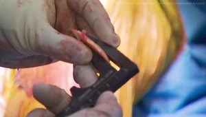 MOTO Lateral Partial Knee – PKR Live Surgery featuring P. Vererfve