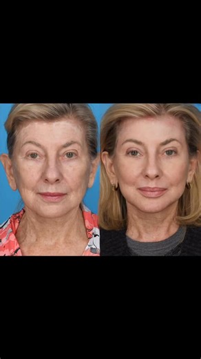 Rod Rohrich on Instagram: "Full face and neck laser resurfacing @ultraclearlaser with laser-coring of neck and lips with a revision hairline browlift and selective facial fat compartment fat grafting at 2 months. No Facelift ! This demonstrates the power of selective facial fat grafting with skin resurfacing of the entire face and neck area with laser-coring for skin tightening of her lower face and neck using single cold fiber erbium technology"