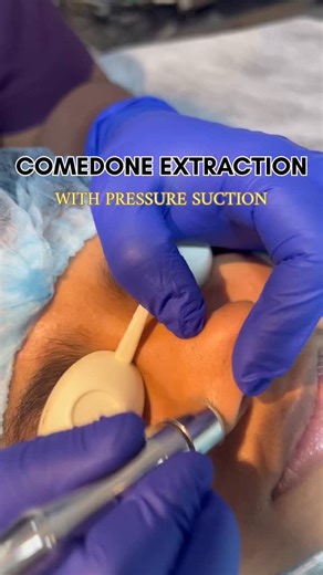 Dr. Thaj Laser Clinic on Instagram: "Comedone extraction with pressure suction is a dermatological procedure used to remove blackheads and whiteheads (comedones) from the skin. The method involves applying controlled suction pressure to gently extract debris from clogged pores, promoting clearer skin and reducing acne formation. #ComedoneExtraction #SuctionExtraction #AcneTreatment #Dermatology #ClearSkin #BlackheadRemoval #WhiteheadExtraction #PoreCleaning #SkinCare #MedicalAesthetics"