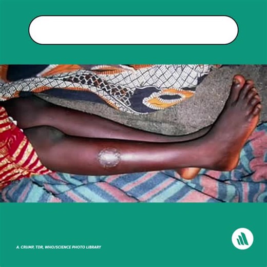 Human African trypanosomiasis is an infection with protozoa of the species Trypanosoma brucei, transmitted by the bite of a tsetse fly. Symptoms include characteristic skin lesions, intermittent fever, headache, rigors, transient edema, generalized lymphadenopathy, and often fatal meningoencephalitis. Learn more: https://mrkmnls.co/3IMK03N | Merck Manual Professional