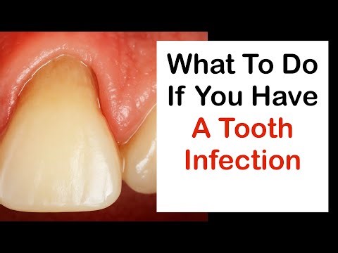 What To Do If You Have A Tooth Infection