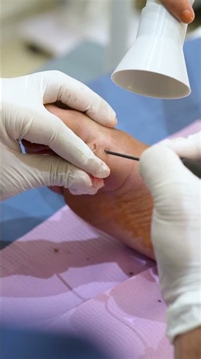 Stubborn Plantar Warts Making Every Step Uncomfortable? Here Is the Fix