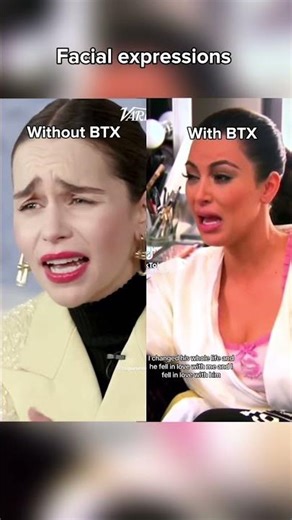 Botox: Frozen Face or Natural Movement?