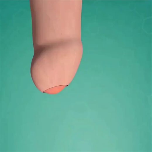 This is how the circumcision procedure is performed: