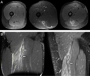 Intramuscular Tendon Tears of the Hamstrings