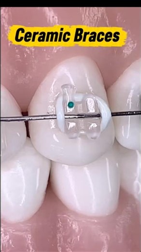 Placing a ceramic bracket 😍 #ceramicbraces #teeth #braces #orthodontist