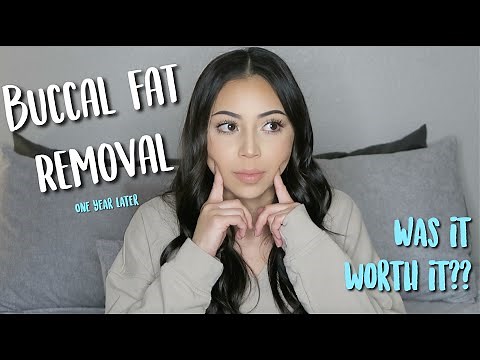 BUCCAL FAT REMOVAL | ONE YEAR UPDATE