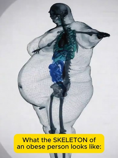 This is what carrying excess weight does to your skeleton 🦴 Your spine, hips, knees, and ankles were engineered to support a certain load. When that load increases significantly, the math changes—and not in your favor. Here's what we see clinically: Spine: Increased pressure on intervertebral discs accelerates degeneration, herniations, and chronic low back pain. The lumbar spine bears the brunt of it. Knees: Every extra pound adds roughly 4 pounds of pressure on your knee joints. Over time, th