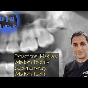 Extra Wisdom Tooth Removal (Supernumerary) Step-by-Step with Voiceover ‪@drwahan‬