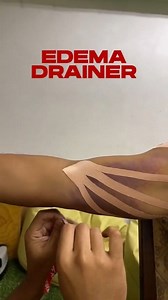 Discover the perfect companion for edema with ATF Sport Taping Tape!  Dive into the healing science and experience the therapeutic precision of taping. Every detail counts on the road to recovery. 啕 #ATFSportsTaping #PlayWithConfidence #EdemaSolutions #TapeAndTransform #ATFSportTapeMagic | ATF Sport Taping | Facebook