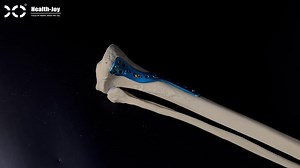 Proximal Tibial Plate Fixation Techniques - Comprehensive Guide