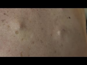 Giant Cysts / Pimple Explosion - Under Pressure