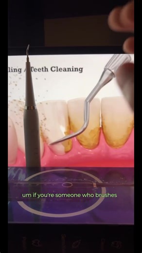 Plaque Remover for Teeth,Tartar Remover for Teeth Cleaning with 3 Replaceable Heads and 5 Adjustable Modes,Rechargeable Teeth Cleaning Plaque Remover for Home