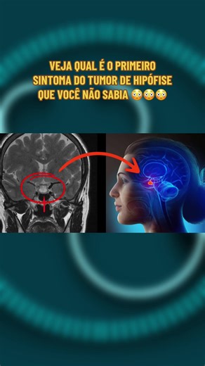 Sintomas do Tumor de Hipófise que Você Não Sabia