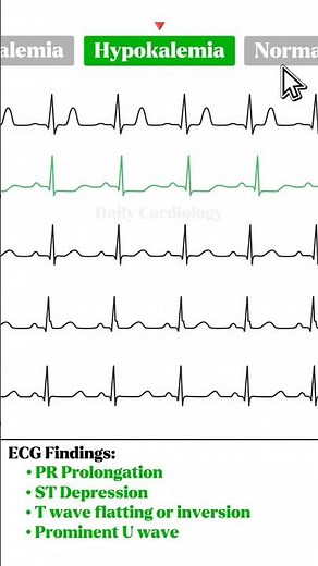 ECG Rhythm comparison (Hyperkalemia, Hypokalemia, Hypercalcaemia, Hypocalcaemia) #ecg #cardiology