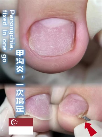 Lele studio by Colour workshop on Instagram: "别再让嵌甲折磨你的每一步！ Stop Letting Ingrown Nails Ruin Every Step You Take! 😫 走路像踩针？嵌甲反复发炎？ 😫 Walking on needles? Ingrown nails inflamed ✅ 无痛非手术 | 即做即走 ✅ Painless & No Surgery | Instant Relief ✅ 科学塑形 | 从根源防止复发 ✅ Scientific Reshaping | Prevents Recurrence 📌 体验价仅 $98！ 📌 Trial Price $98! 👇 马上点击预约，告别嵌甲痛苦！ 👇 Book Now & Say Goodbye to Pain! 📱 Call/WhatsApp: 8659 7968 #嵌甲救星 #IngrownNailSolution #无痛矫正 #CrystalPowderNail #新加坡足部护理 #SGFootCare #限时体验 #walkwithoutp
