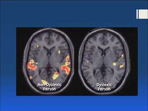 Dyslexia 1