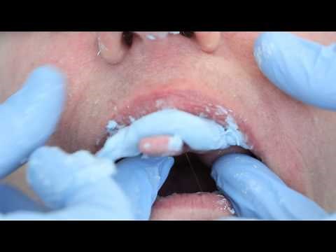 Removable partial denture maxillary definitive impression technique