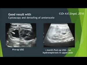 Cystoscopy & deroofing treatment for ureterocele in a child- Dr A.K.Singal, Mumbai, India