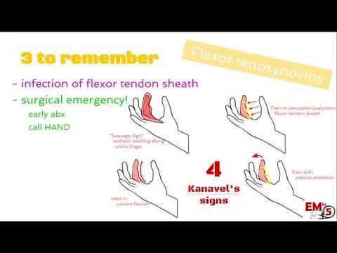 Flexor Tenosynovitis