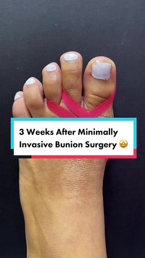 3 Weeks After Minimally Invasive Bunion Surgery: Patient Progress Update