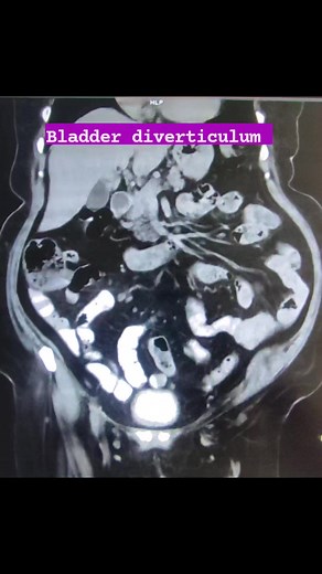 1K views · 51 shares | Urinary bladder diverticulum are protrusions...
