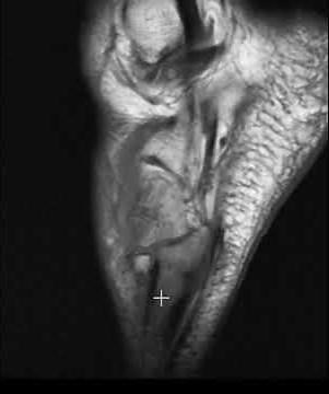 Stress fracture in foot in runner