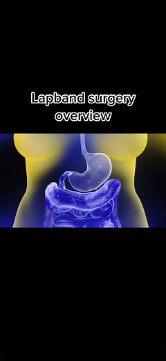 Lapband surgery overview. #azweightloss #wls #lapband #lapbandsurgery