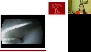 Discoid Meniscus: Surgical Tips and Tricks