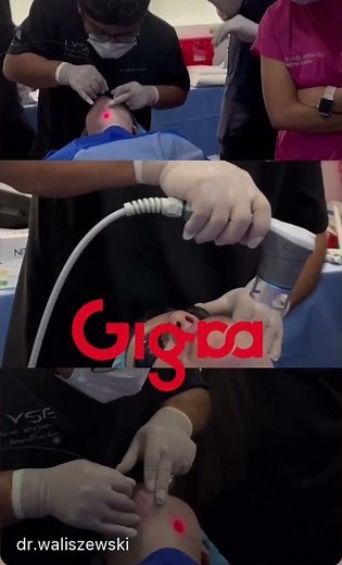 Laser-assisted lipolysis, endolift, skinlift