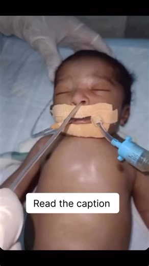 Deepanshu Prajapati (MEDCO DEEPANSHU) on Instagram: "Endotracheal Intubation (Neonatal Intubation) 👶🫁 Definition: Neonatal endotracheal intubation is a life-saving procedure in which an endotracheal tube (ETT) is inserted through the newborn’s mouth (or nose) into the trachea to secure the airway and provide assisted ventilation. ⸻ ✅ Indications • Respiratory distress syndrome (RDS) • Birth asphyxia • Meconium aspiration • Apnea or poor respiratory effort • During neonatal resuscitation • Seve
