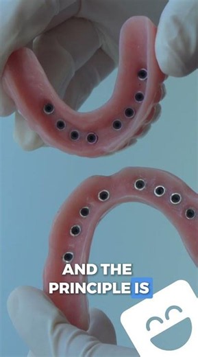 Ever wondered how Snap-in Dentures actually stay in place? Here’s the magic behind it 👇