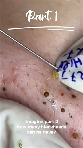 Imagine part 2, how many blackheads can he have?