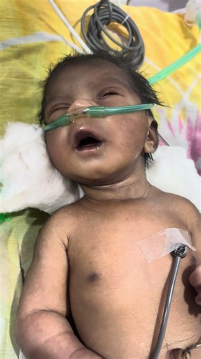 Critical Baby on CPAP Machine | NICU Oxygen Support #CriticalBaby #CPAP #OxygenSupport #BabyCare