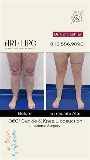 ArtLipo Liposuction & Lipedema Surgery on Instagram: "Before ➝ immediate after 🤩 360° Cankle & Knee Liposuction for lipedema, performed by Dr. George Kardashian 💫 This before-and-immediate-after shows both legs fully treated, with visible reduction in bulk around the knees and cankles. Lipedema commonly collects in these areas, affecting comfort, mobility, confidence, and natural contours. @artlipo_lipedema_surgery By treating the knees and lower legs circumferentially, we’re able to restore b