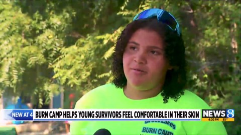 Burn camp helps young survivors feel comfortable in their own skin