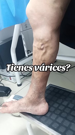 Cirugía láser endovascular para tratar várices en Perú