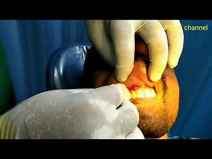 #Dental infection,#incision and drainage of dentoalveolar abscess