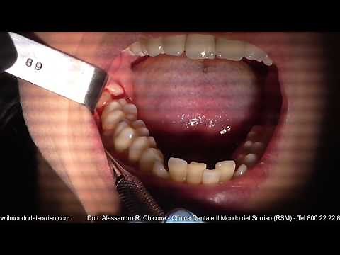 Estrazione dente del giudizio incluso / Dr. Alessandro R. Chicone / www.ilmondodelsorriso.com