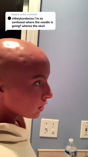 Managing Alopecia with Kenalog Injections