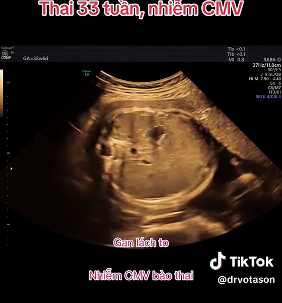 Nhiễm trùng bào thai CMV ở tuần 33
