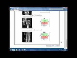Webinar: Bone Densitometry Reporting in High Volume Practices