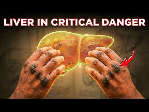 5 Signs of Fatty Liver Disease on Your Hands — Warning Symptoms You Shouldn't Ignore!