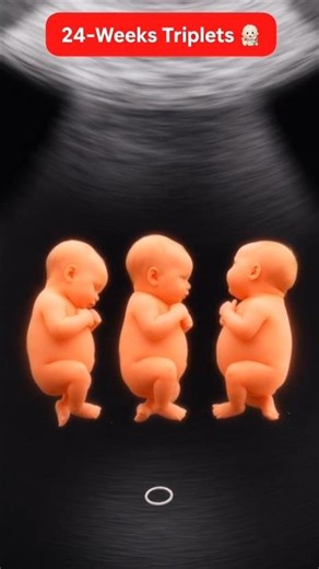 24 Weeks Ultrasound Scan of Triplets Fetuses | 6 Months Rare Pregnancy
