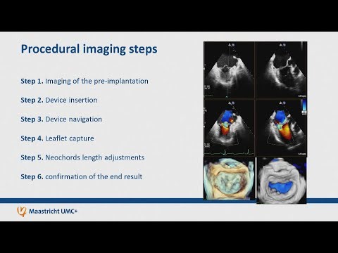 ISMICS 2025 | Beating Heart Redo Mitral Valve Repair With Neochords