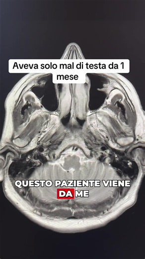 Meningioma con edema peritumorale: risonanza magnetica e gestione