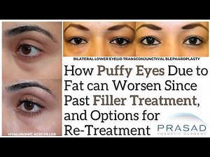 How Eye Bags can Worsen Since Filler Treatment, and a Definitive Puffiness Treatment