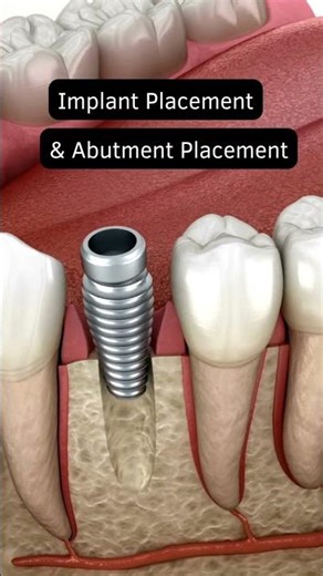 Tooth Implant Process
