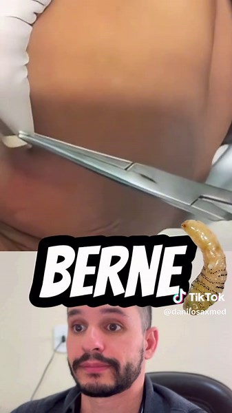 O berne, também denominado de dermatobiose, é uma infecção causada pela larva da Mosca Dermatobia hominis, conhecida no Brasil pelo nome popular de “mosca varejeira”. Desenvolve-se no tecido subcutâneo de diversos animais, principalmente os bovinos, e também de humanos. Esta infecção é um tipo de miíase, porém a lesão causada por esta larva é diferente. Esta mosca possui um hábito de ovoposição distinto das outras, pois ela necessita de outro inseto, que geralmente é também outra espécie de mosc